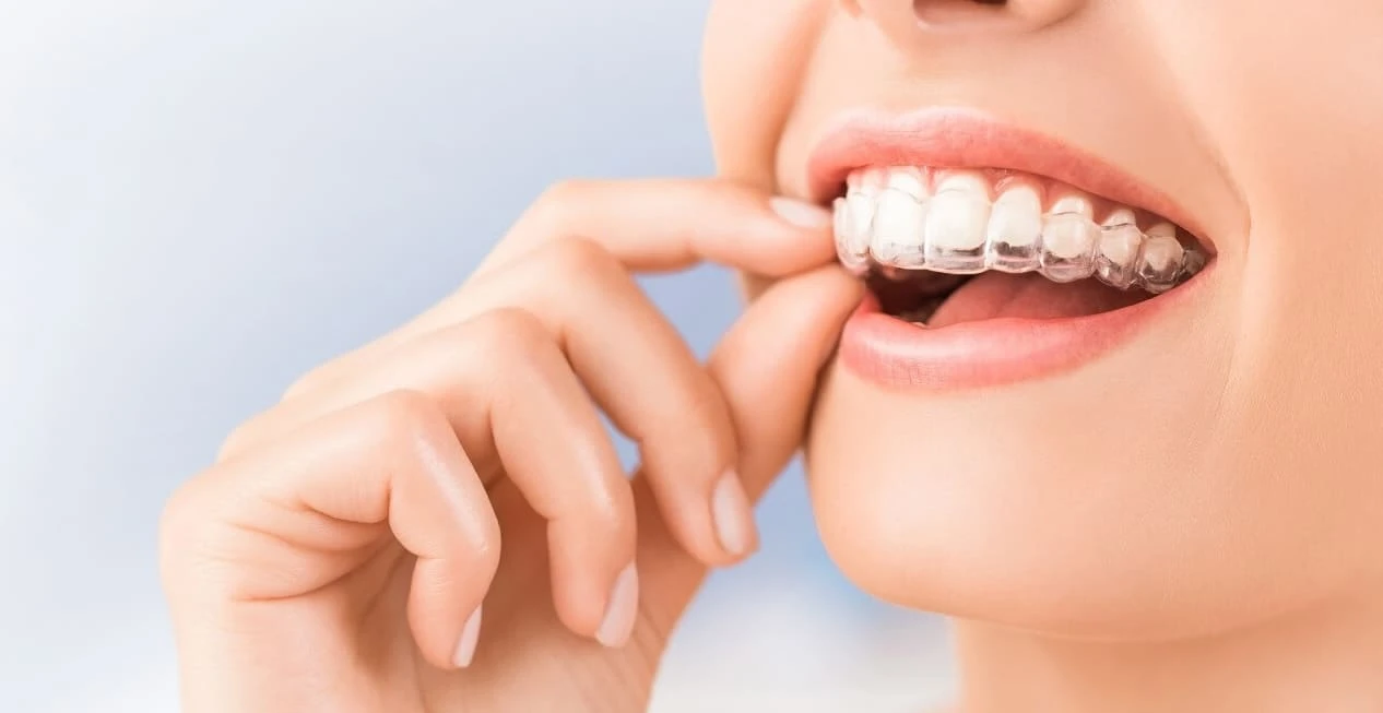 Invisalign - nevidni aparat - ortodontija