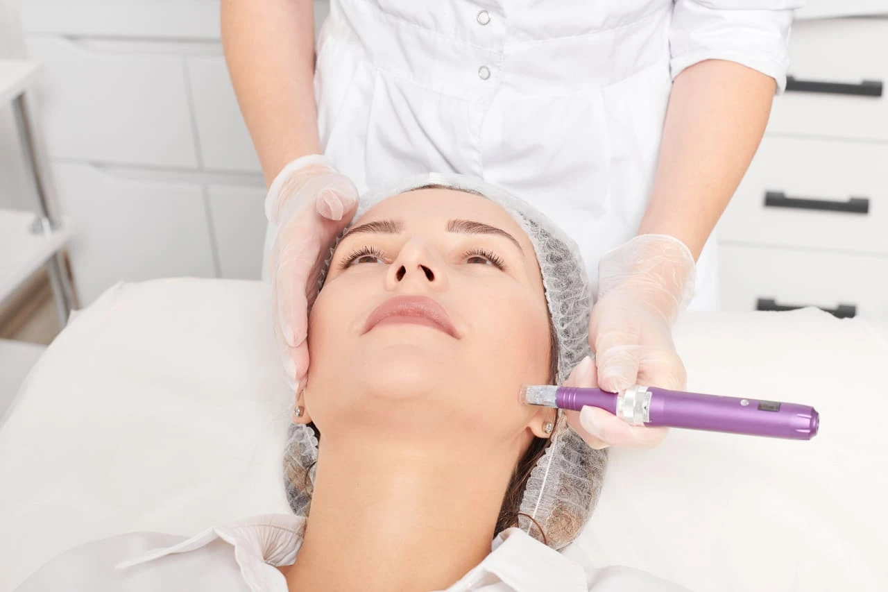 Microneedling - mezoterapevtska procedura